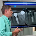 Impianto dentale a Trezzano sul Naviglio: dolore dopo implantologia dentale, cosa è normale e quando rivolgersi al dentista