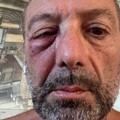 Runner colpito all'occhio da un uovo scagliato da un'auto sul lungomare di Bari