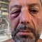 Runner colpito all'occhio da un uovo scagliato da un'auto sul lungomare di Bari